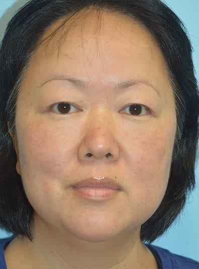 Before Image: Eyelid Surgery - front