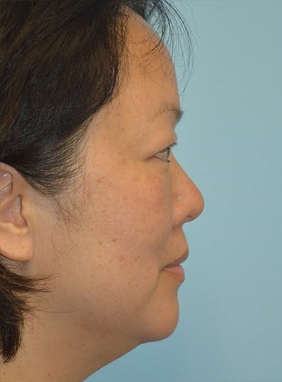 Before Image: Eyelid Surgery - right-side