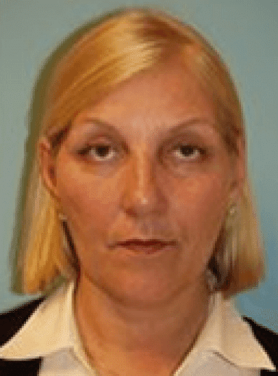 Before Image: Eyelid Surgery - front