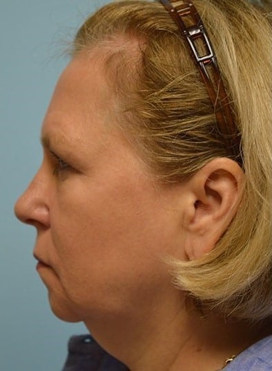 Before Image: Facelift - left-side