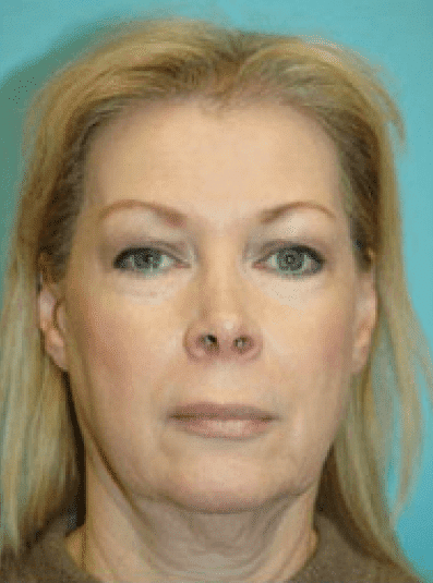 Before Image: Facelift - front