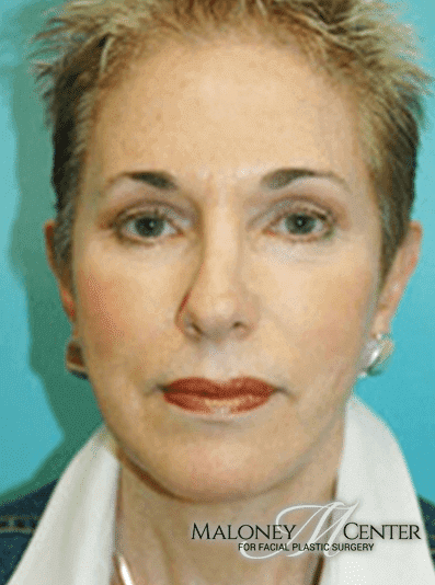 After Image: Facelift - front