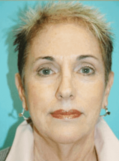 Before Image: Facelift - front