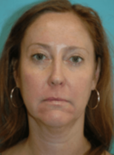 Before Image: Facelift - front