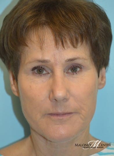 After Image: Facelift - front