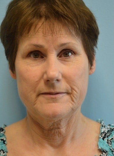 Before Image: Facelift - front