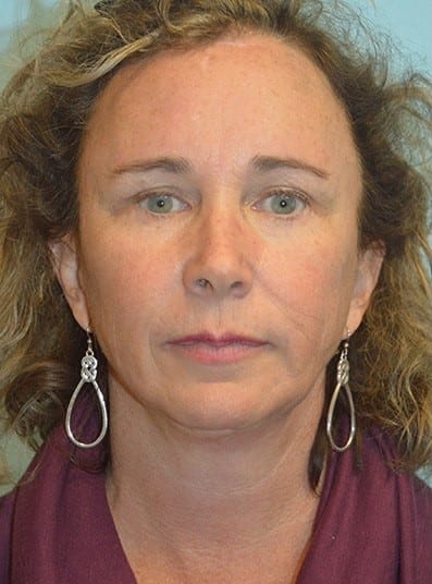 Before Image: Facelift - front
