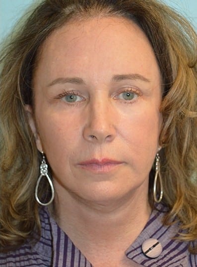 After Image: Facelift - front