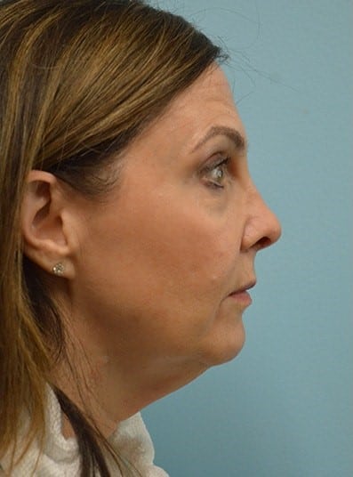 Before Image: Facelift - right-side