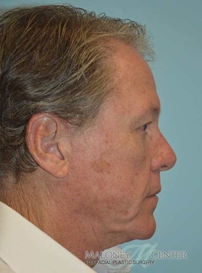 After Image: Facelift - right-side