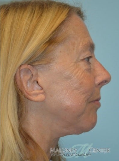 After Image: Facelift - right-side