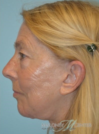 After Image: Facelift - left-side
