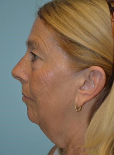 Before Image: Facelift - left-side