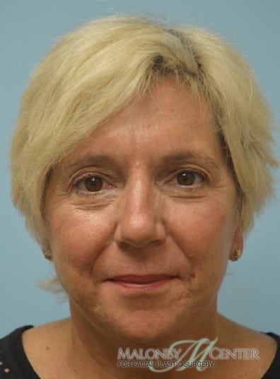 After Image: Facelift - front