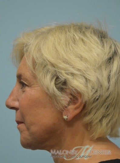 After Image: Facelift - left-side