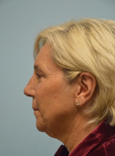 Before Image: Facelift - left-side