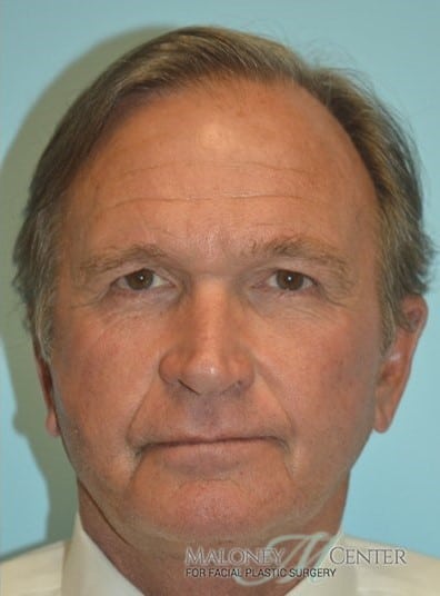 After Image: Facelift - front