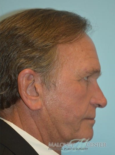 After Image: Facelift - right-side