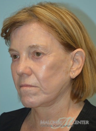 After Image: Facelift - left-front-oblique