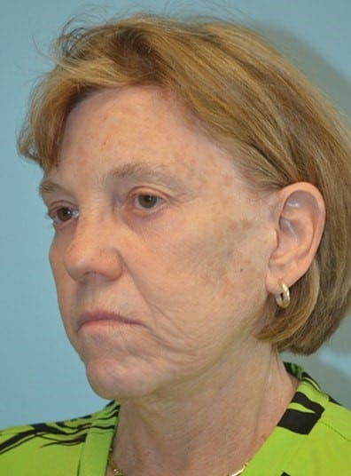 Before Image: Facelift - left-front-oblique