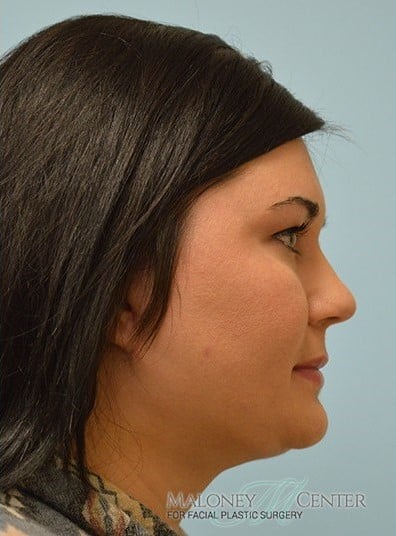 After Image: Facelift - right-side