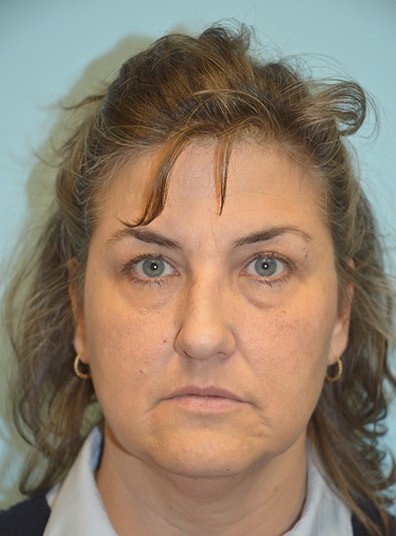Before Image: Facial Fat Transfer - front