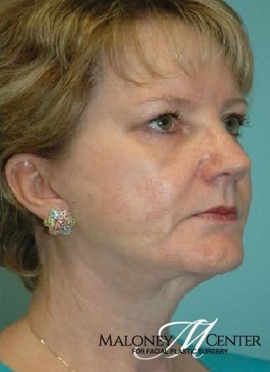 After Image: Facial Fat Transfer - right-front-oblique