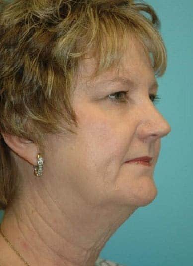 Before Image: Facial Fat Transfer - right-front-oblique
