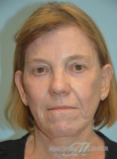 After Image: Chemical Peel - front
