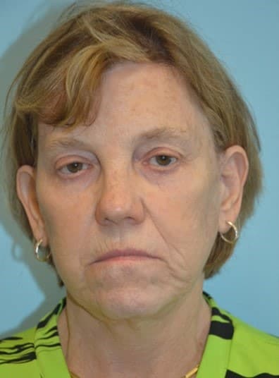 Before Image: Facial Fat Transfer - front