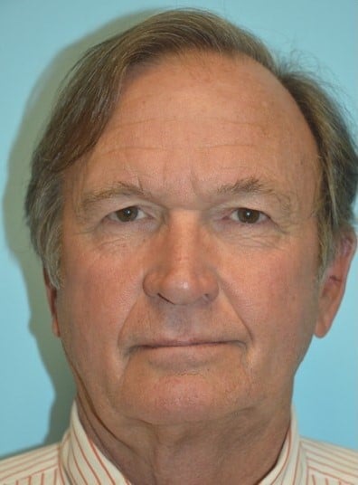 Before Image: Facial Fat Transfer - front
