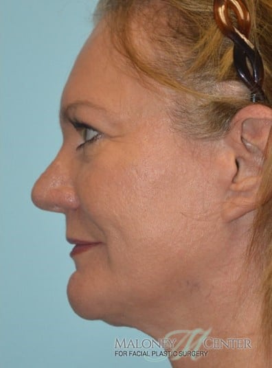 After Image: Facial Fat Transfer - left-side