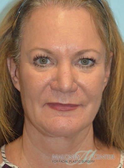 After Image: Facial Fat Transfer - front