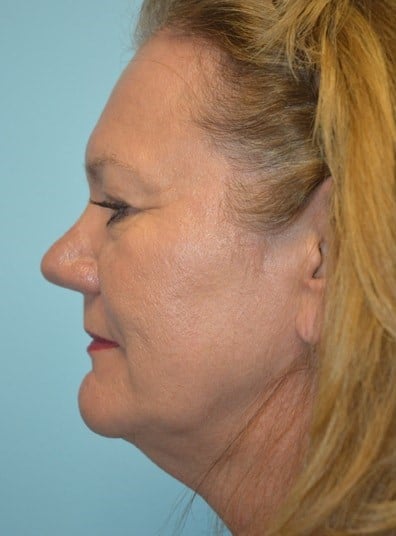 Before Image: Facial Fat Transfer - left-side