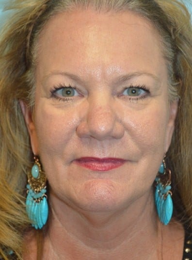 Before Image: Facial Fat Transfer - front