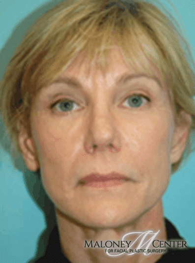 After Image: Facial Fat Transfer - front