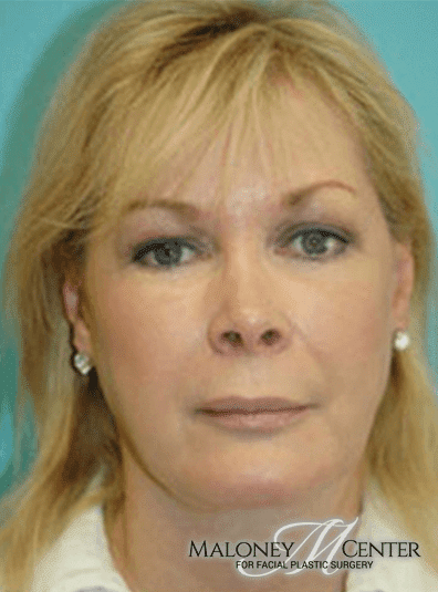 After Image: Facial Fat Transfer - front