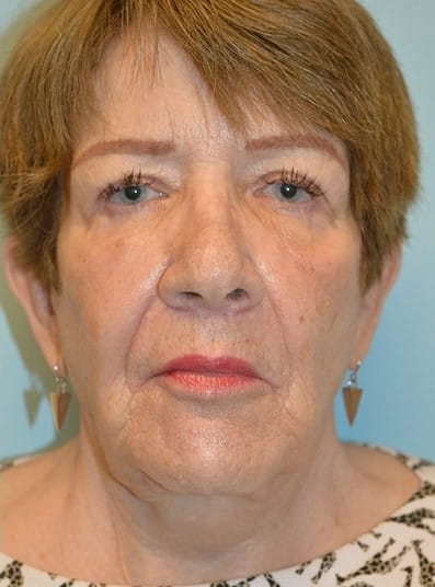 After Image: Facial Fat Transfer - front