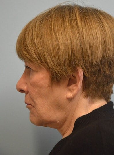 After Image: Facial Fat Transfer - left-side