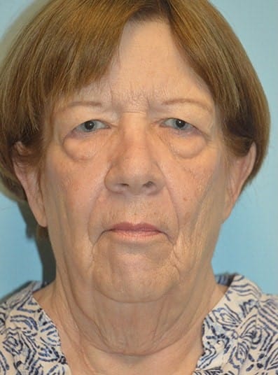 Before Image: Facial Fat Transfer - front
