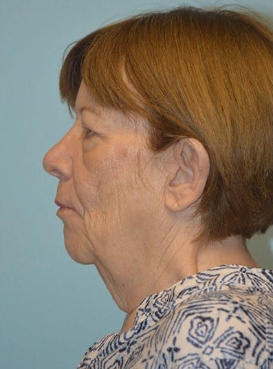Before Image: Facial Fat Transfer - left-side