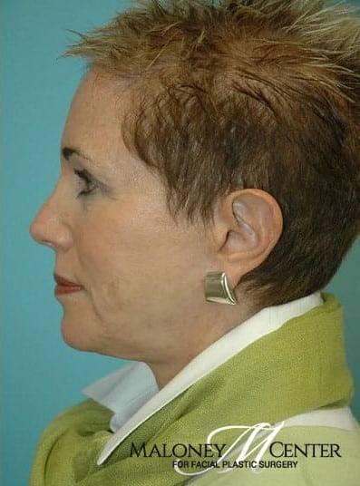After Image: Facial Fat Transfer - left-side