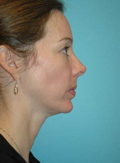 After Image: Facial Implant - right-side