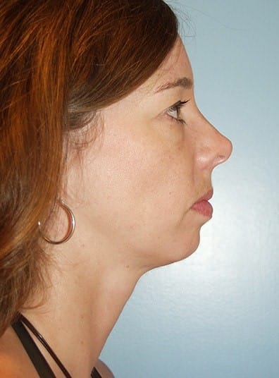 Before Image: Facial Implant - right-side