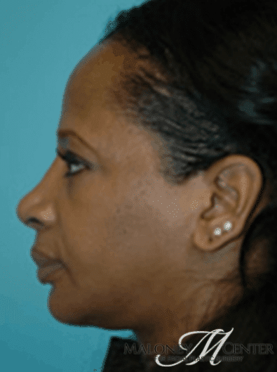 After Image: Facial Implant - left-side