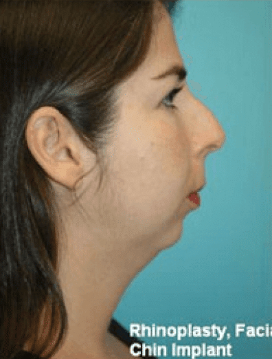 Before Image: Facial Implant - right-side