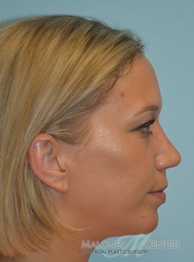 After Image: Facial Implant - right-side