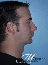 After Image: Facial Implant - right-side