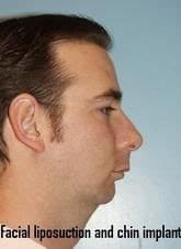 Before Image: Facial Implant - right-side