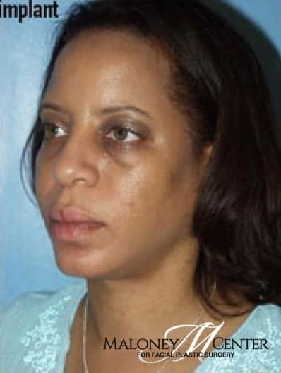 After Image: Facial Implant - left-front-oblique